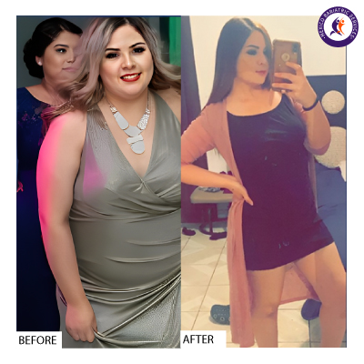 Gastric Bypass Before and After Gastric Bypass Surgery Before and After