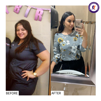 Gastric Bypass Before and After Gastric Bypass Surgery Before and After