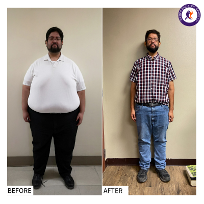 Gastric Bypass Before and After Gastric Bypass Surgery Before and After