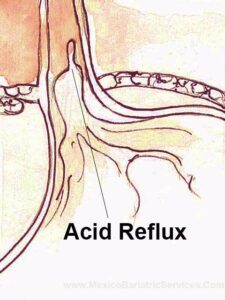 GERD (Acid Reflux) After Gastric Sleeve