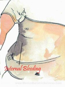Internal Bleeding Post Gastric Sleeve Surgery