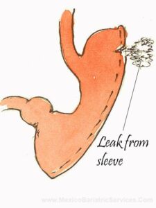 Sleeve Gastrectomy Leak from Pouch