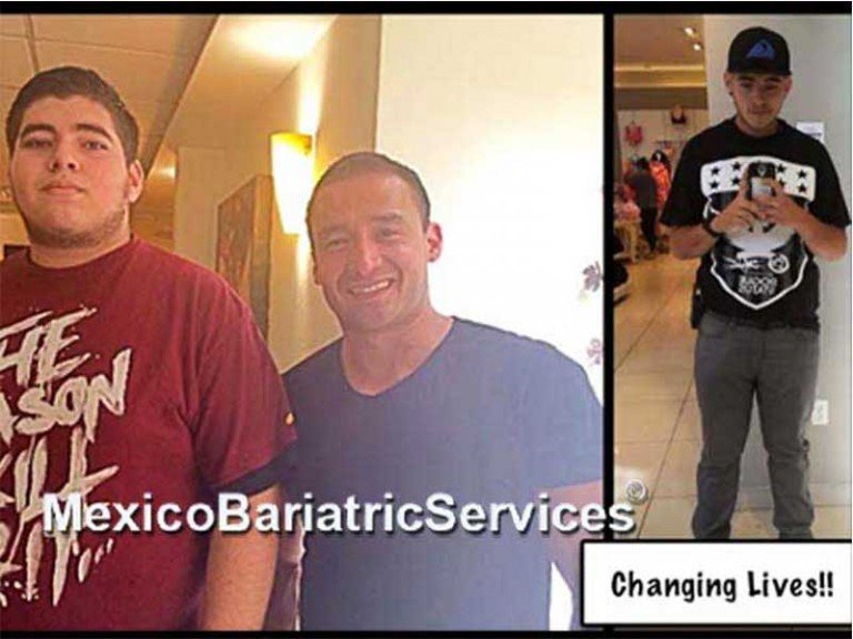 Before And After Gastric Sleeve In Tijuana Mexico