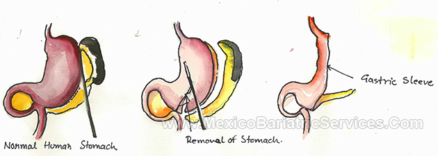 Gastric Sleeve in Cancun - Mexico