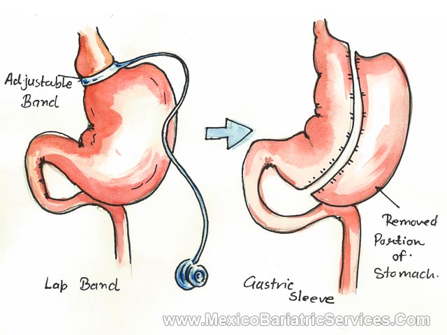 What is lap band surgery?