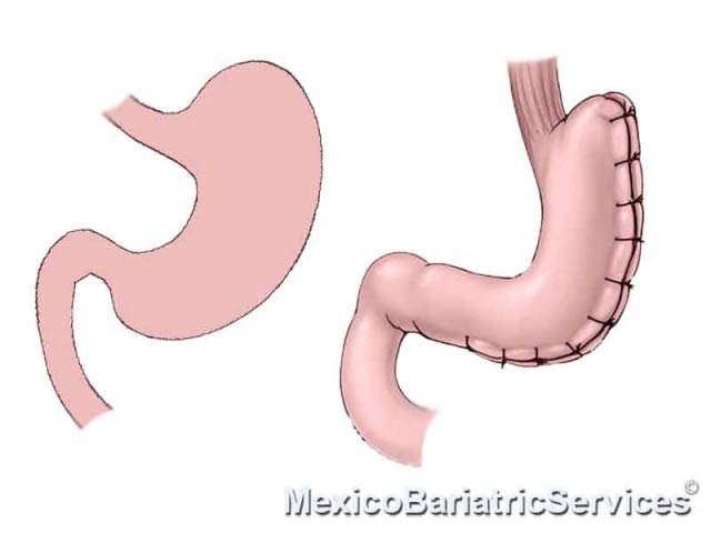 Gastric Plication in Mexico