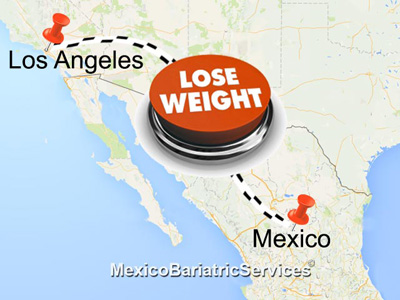 Weight Loss Surgery in Mexico for Los Angeles Residents
