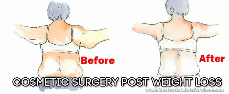 Cosmetic Surgery in Mexico After Weight Loss Surgery