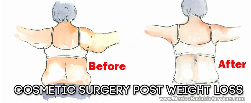 Plastic Surgery After Bariatric Surgery in Mexico