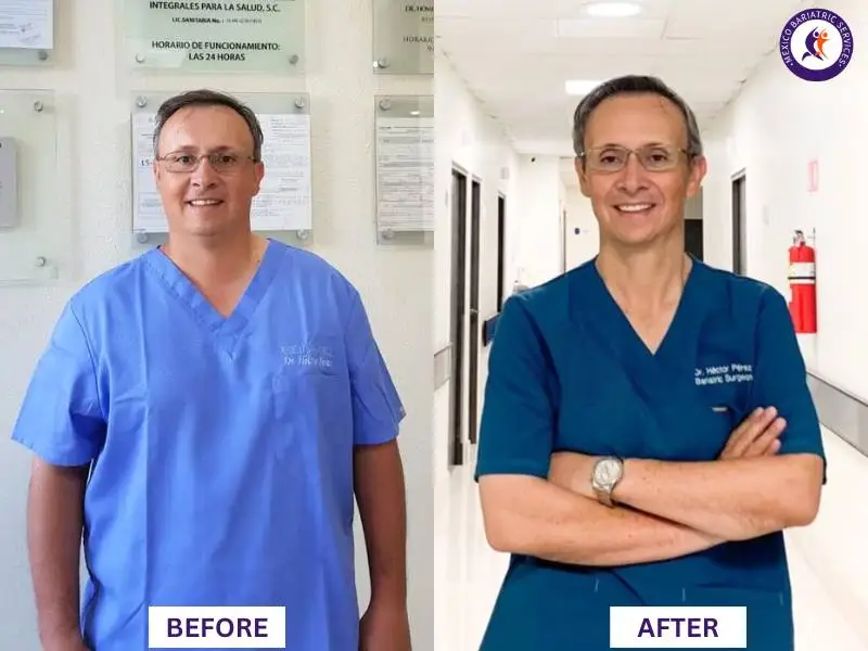 Dr. Hector Perez Corzo Before and After Bariatric Surgery