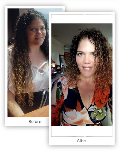 Before and After Gastric Bypass Surgery Pictures - Mexico
