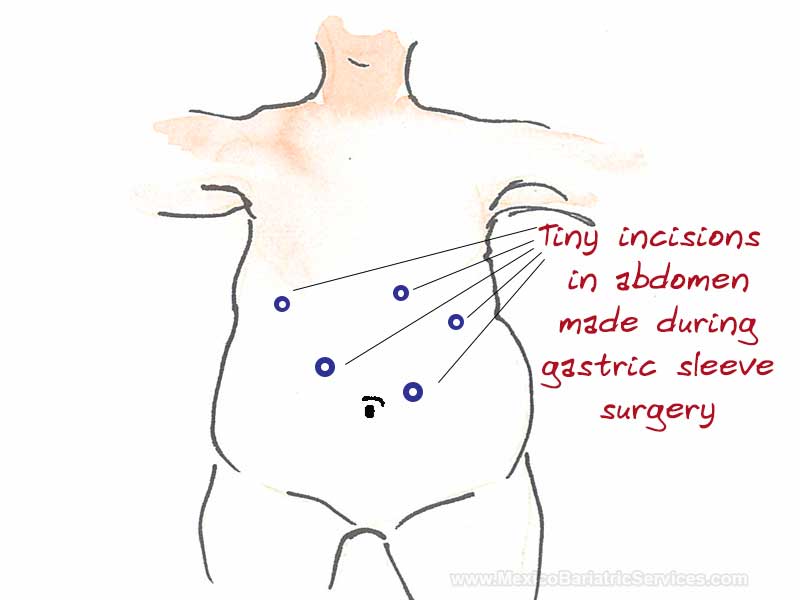 Gastric Sleeve Procedure - Incisions