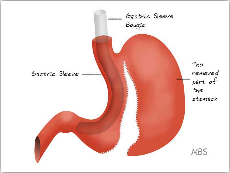 Gastric-Sleeve-Bougie