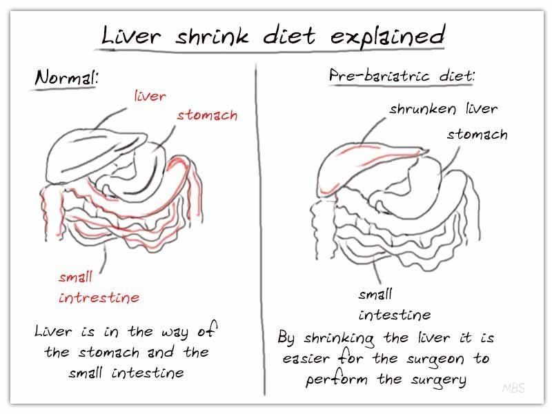 Liver Shrink Diet Before Bariatric Surgery