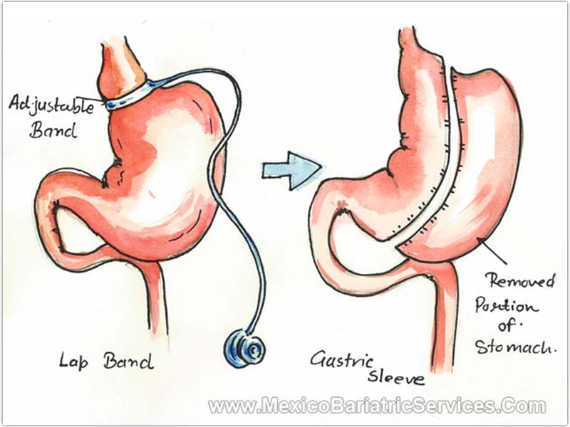 Revision Bariatric Surgery in Mexico