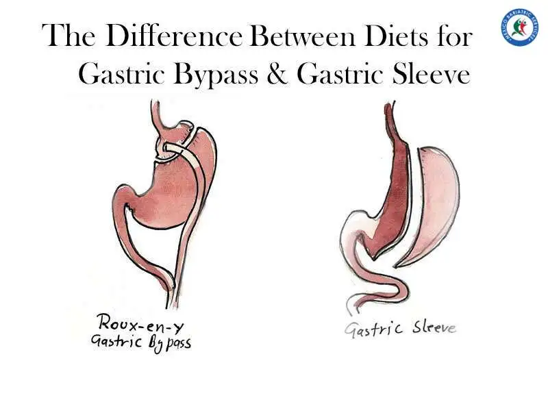 Difference Between Diets for Gastric Sleeve and Bypass