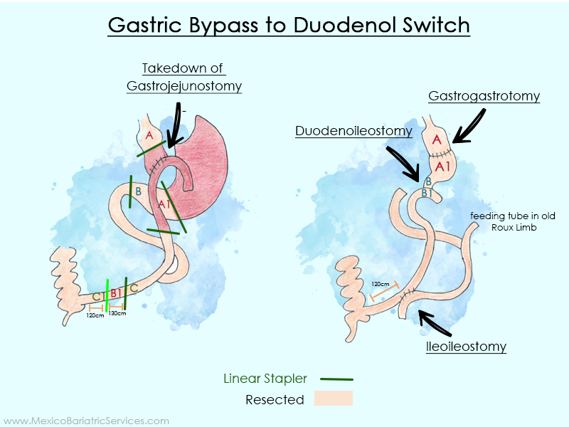Gastric Bypass to Duodenal Switch revision surgery in Mexico