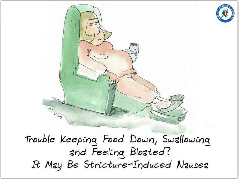 Nausea Caused by Strictures After Bariatric Surgery