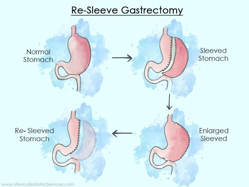 Resleeve Gastrectomy