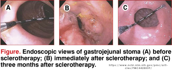 Endoscopic Sclerotherapy to Shrink Stoma