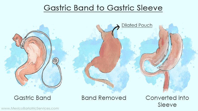 Gastric Band to Gastric Sleeve