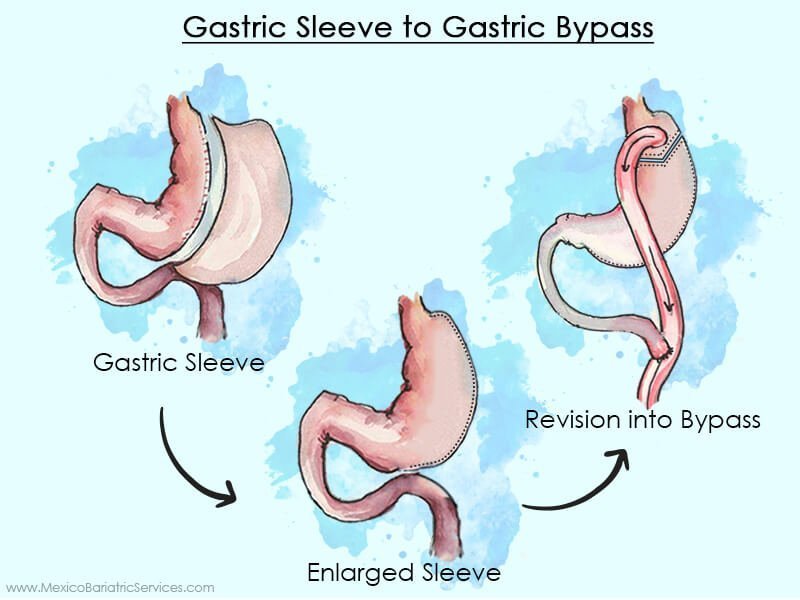 Gastric Sleeve to Gastric Bypass
