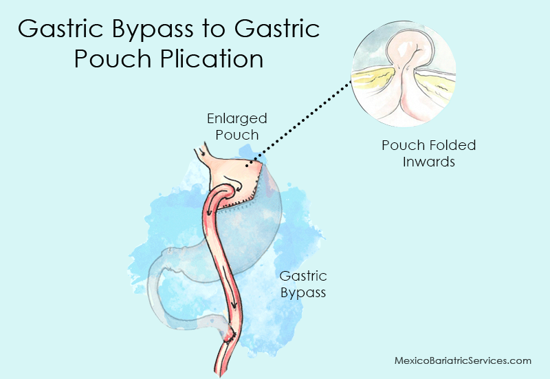 Gastric Pouch Plication after failed Gastric Bypass in Mexico