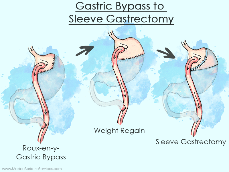 Gastric Bypass to Sleeve Gastrectomy revision surgery in Mexico