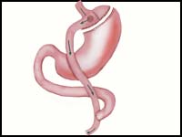 Gastric Bypass RYGB Qualifications