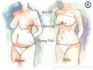 Mommy Makeover After Bariatric Surgery Mommy Makeover After Bariatric Surgery