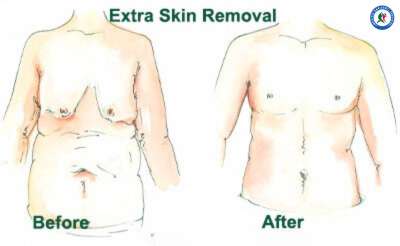 Plastic Surgery After Bariatric Surgery in Mexico Plastic Surgery After Bariatric Surgery in Mexico