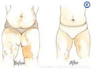 Tummy Tuck Before and After Tummy Tuck Before and After