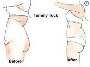 Tummy Tuck in Mexico Before and After Tummy Tuck Before and After