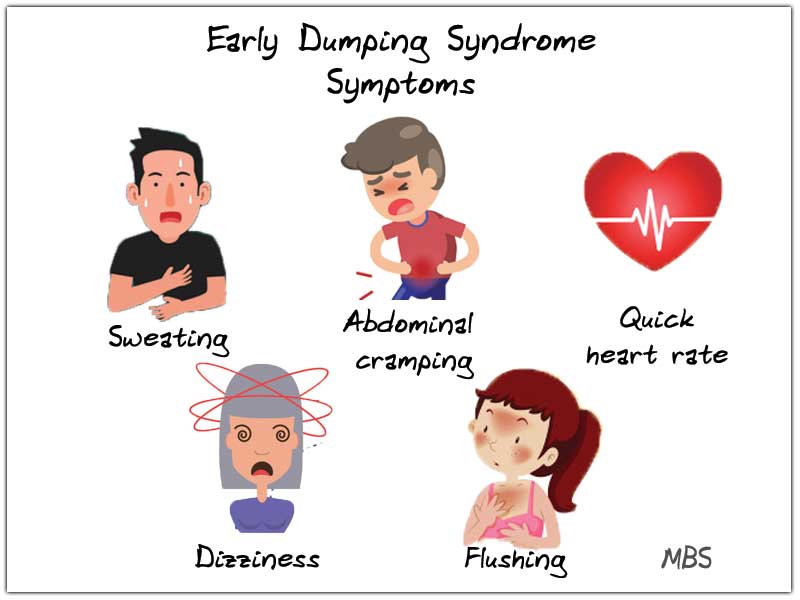 Early Dumping Syndrome Symptoms Bariatric Surgery