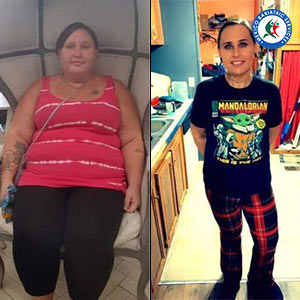 Bariatric Surgery by Dr. Cazares Before After