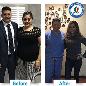 Gastric Sleeve in Nuevo Laredo, Mexico: Before & After