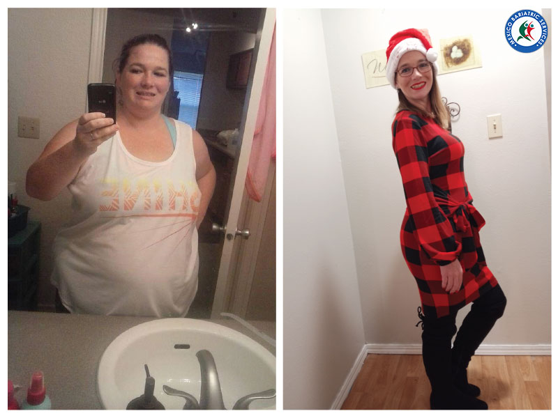 Lea Ann's Before & After Images | Mexico Weight Loss Surgery Reviews