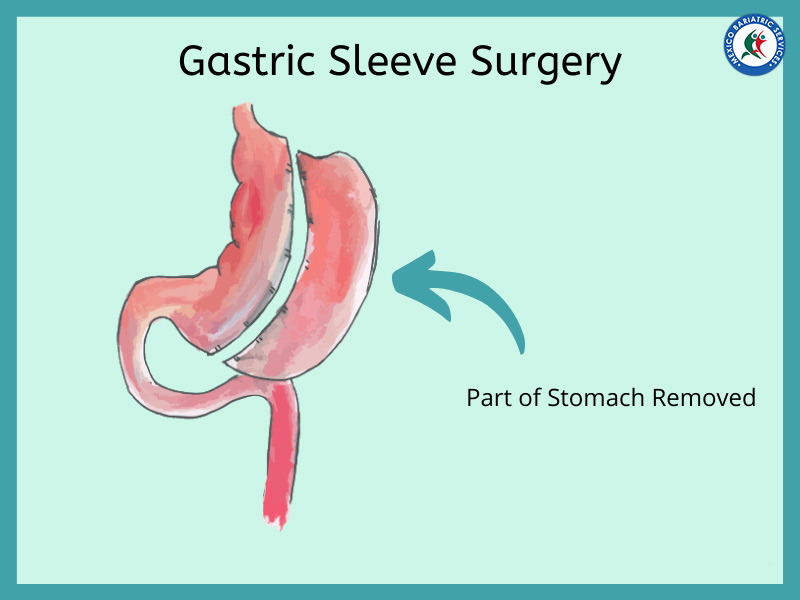 Part of Stomach Removed in Gastric Sleeve Surgery