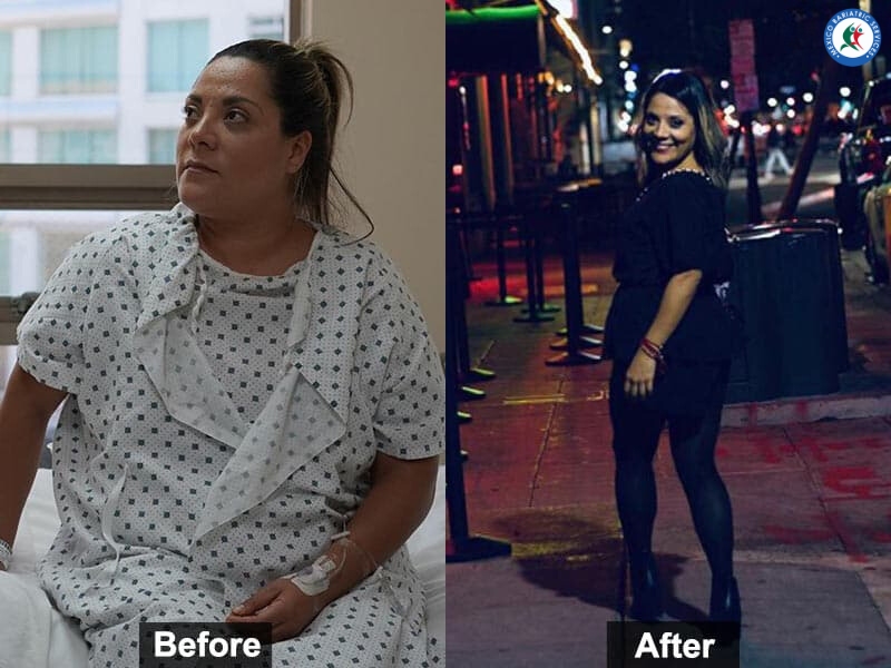 Tijuana gastric sleeve before and after