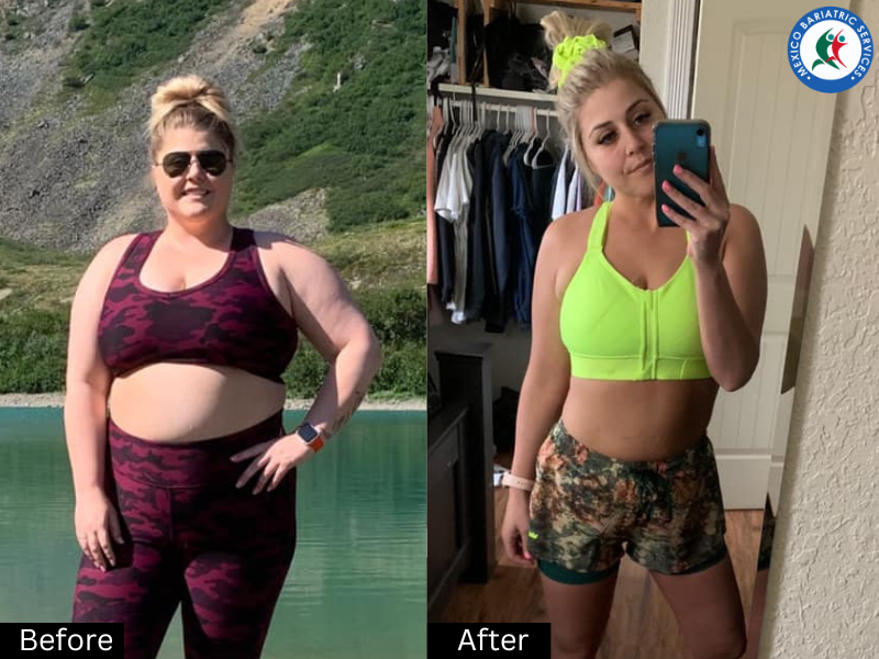 Before and After Gastric Sleeve in Mexico