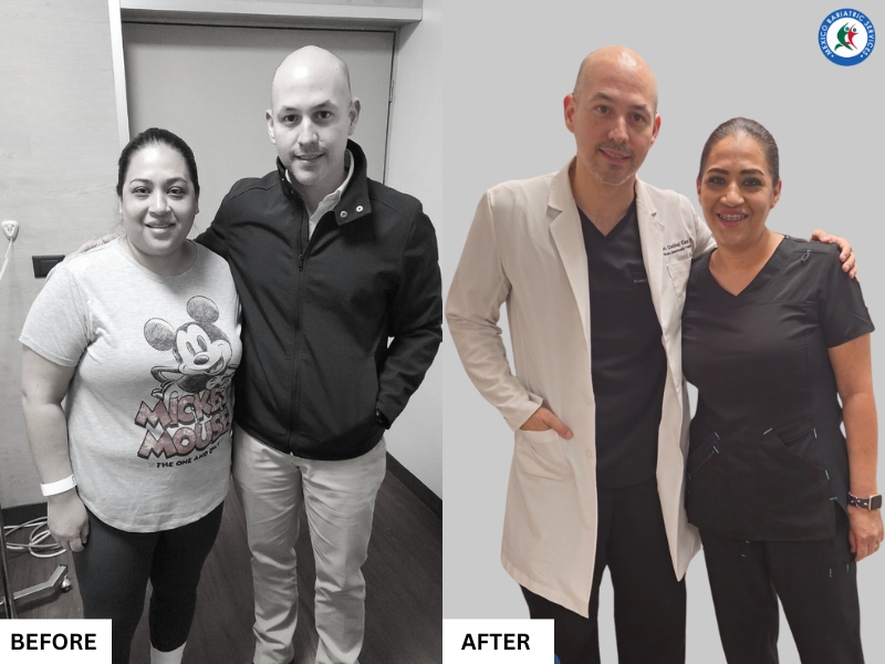Bariatric Surgery in Piedras Negras, Mexico | Before & After