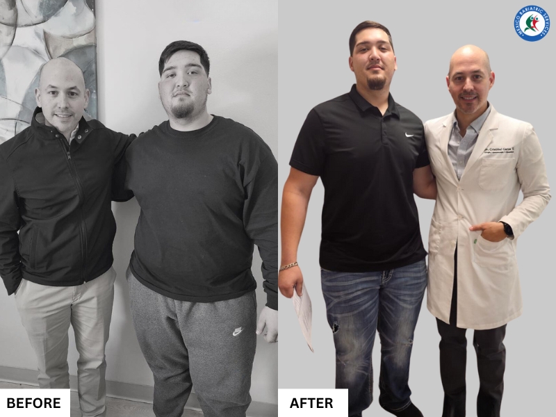 Bariatric Surgery in Piedras Negras, Mexico | Before & After