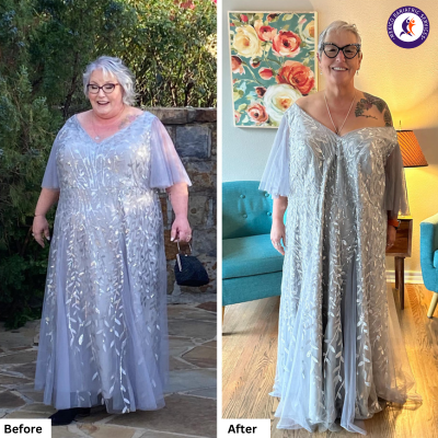 Before and after pictures of Lisa Mae’s from Texas, USA, after a gastric bypass in Tijuana.