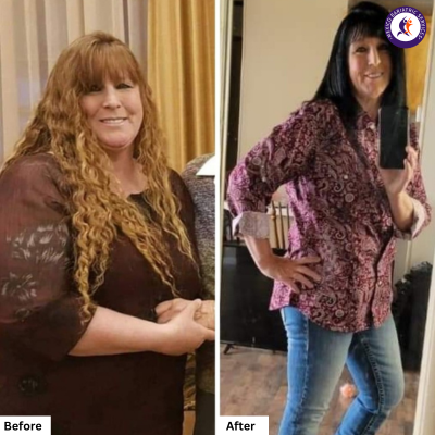Before and after pictures of Wendy Medrano from Idaho, USA, after weight loss surgery in Tijuana