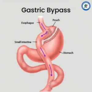 Gastric Bypass in Piedras Negras, Mexico