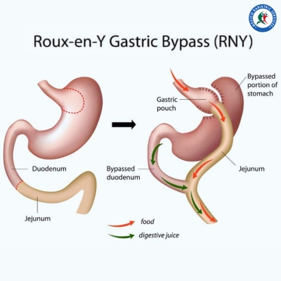 Gastric Bypass Surgery in Texas Mexico Border
