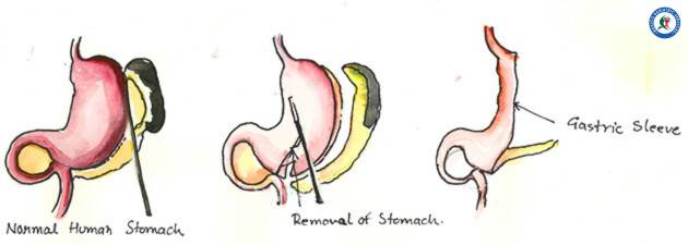 Gastric Sleeve in Cancun Mexico