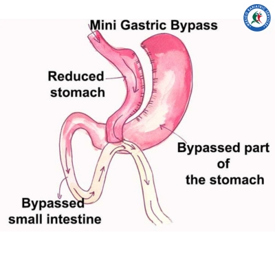 Mini Gastric Bypass in Texas Mexico Border