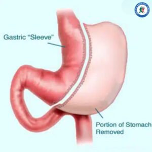 Mini Laparoscopic Sleeve in Piedras Negras