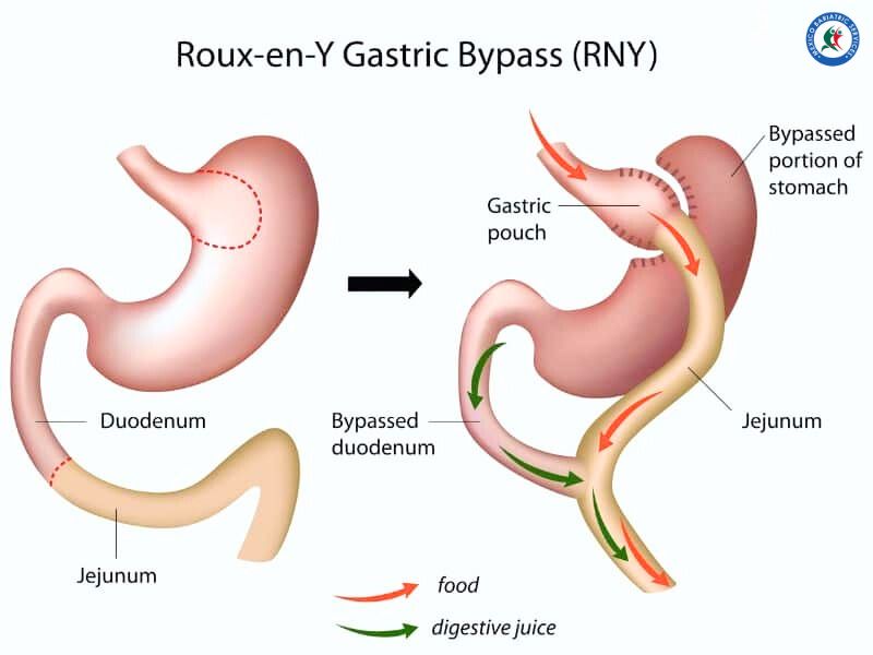 Gastric Bypass Surgery in Cancun Gastric Bypass in Cancun